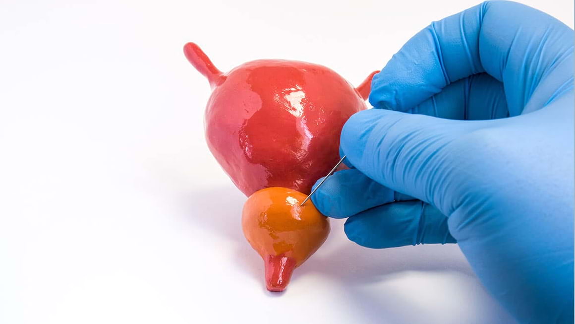 Adenomul de prostata (hiperplazia benigna de prostata sau prostata marita): Simptome, Cauze, Tratament - Doc.ro